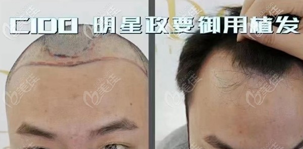 男士额角植发术前图 男士额角植发术前图
