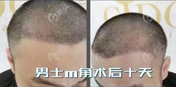 用熙朵案例解答种植额角两边头发需要多少毛囊，多图展示他种发2000单位的效果