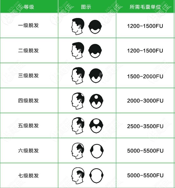 男士额角脱发种植毛囊数量图 男士额角脱发种植毛囊数量图