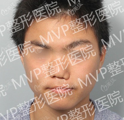 唇腭裂导致的鼻子塌陷 唇腭裂导致的鼻子塌陷