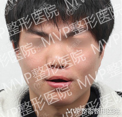 单侧唇裂导致的鼻孔塌陷在韩国MVP整形医院做修复后,鼻子终于对称了