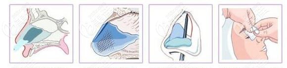 唇腭裂鼻子塌陷修复办法 唇腭裂鼻子塌陷修复办法