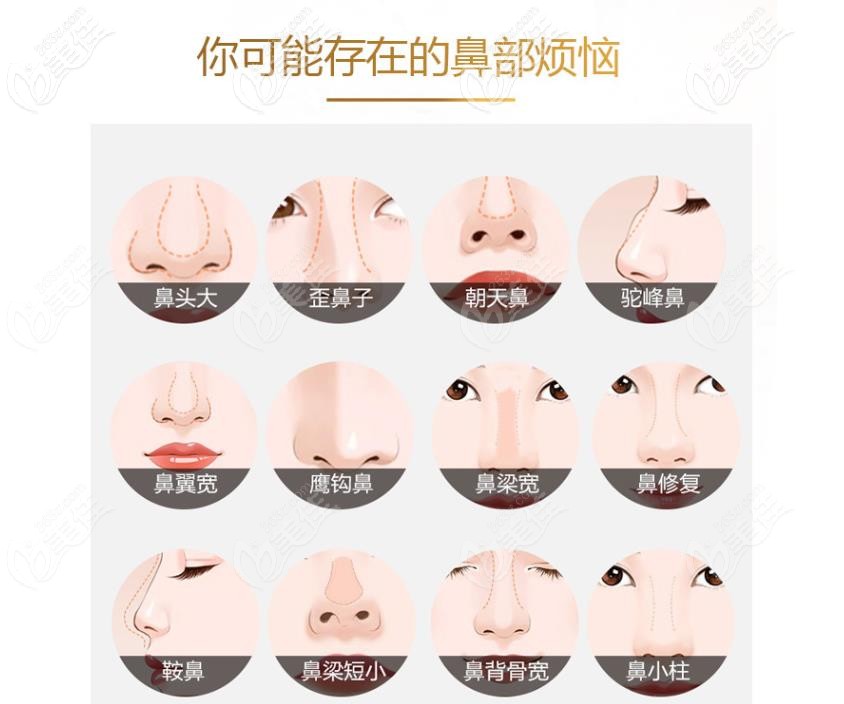 鼻头大、朝天鼻、歪鼻都可以做隆鼻手术改善