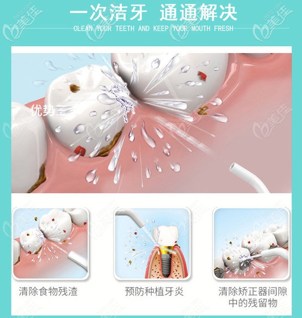 超声波洁牙可预防种植牙炎 超声波洁牙可预防种植牙炎