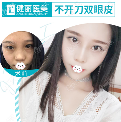 广州健丽镭射定位双眼皮是怎么做的 广州健丽镭射定位双眼皮是怎么做的