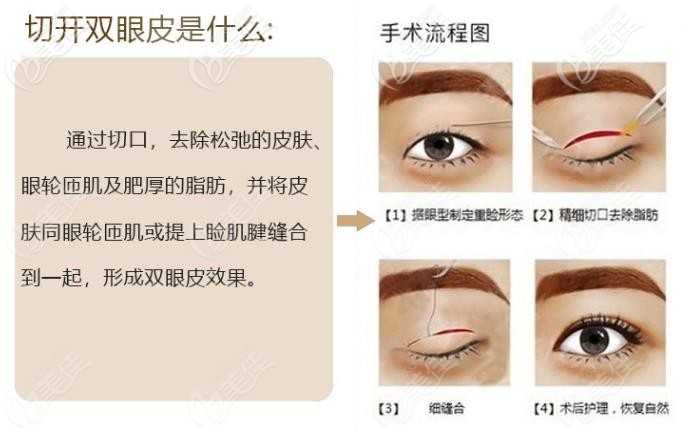 芜湖名姝医院姚福东医生双眼皮怎么做？
