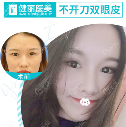 广州健丽镭射定位双眼皮的技术到底靠谱吗 广州健丽镭射定位双眼皮的技术到底靠谱吗