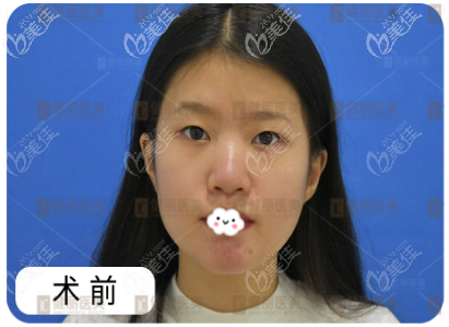 广州健丽医美做完镭射定位双眼皮亲身经历 广州健丽医美做完镭射定位双眼皮亲身经历