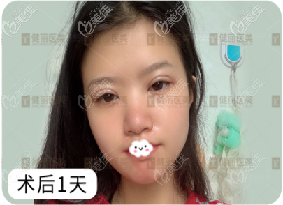 镭射定位双眼皮术后头一个天恢复过程 镭射定位双眼皮术后头一个天恢复过程