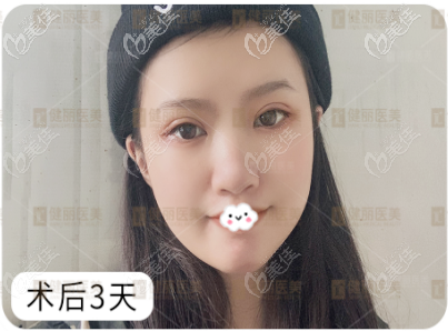 镭射定位双眼皮术后三天疗效图 镭射定位双眼皮术后三天疗效图