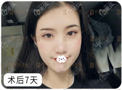 广州健丽医美镭射定位不开刀双眼皮恢复过程图片 广州健丽医美镭射定位不开刀双眼皮恢复过程图片