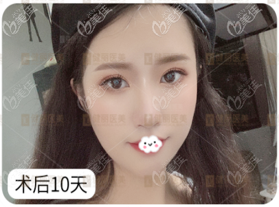 广州健丽镭射定位双眼皮恢复过程图片 广州健丽医美镭射定位双眼皮术后10天恢复过程反馈 广州健丽镭射定位双眼皮恢复过程图片 广州健丽医美镭射定位双眼皮术后10天恢复过程反馈