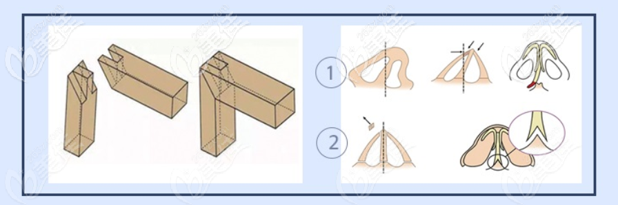 <!--<i data=20240703-sp></i>-->医疗美容门诊部鼻部整形 <!--<i data=20240703-sp></i>-->医疗美容门诊部鼻部整形