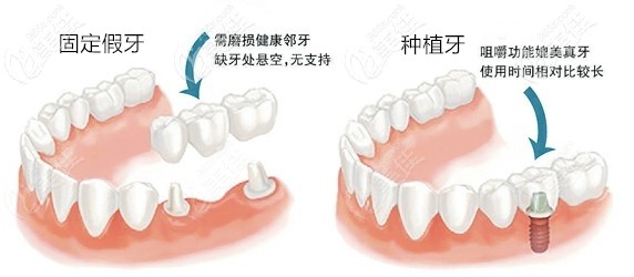 种植牙和固定义齿