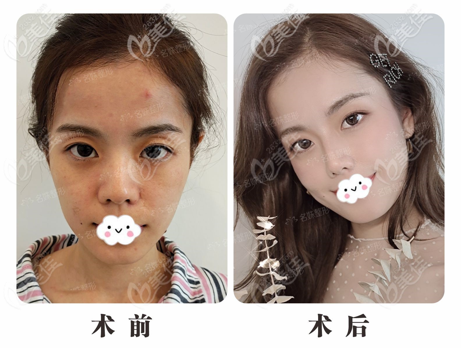 芜湖名姝隆鼻手术怎么样？李瑞主任鼻综合案例