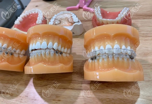 博德口腔牙齿矫正价格