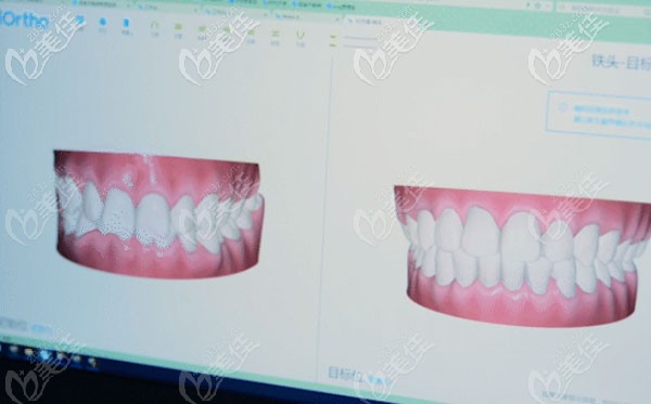 贝壳口腔引进有口腔扫描仪 贝壳口腔引进有口腔扫描仪