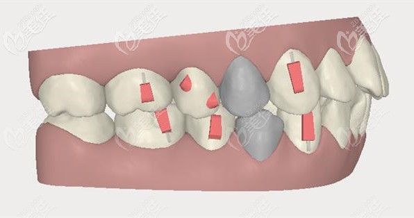 灰色部位是需要拔掉的牙齿 灰色部位是需要拔掉的牙齿