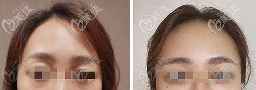 面部脂肪填充真人实例