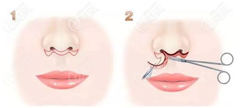 人中缩短手术过程 人中缩短手术过程