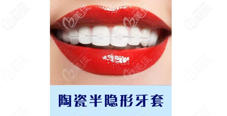 陶瓷半隐形托槽矫正价格在这里了