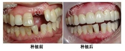 种植牙前后对比照