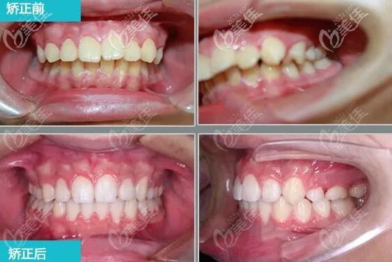 上颌前突下颌后缩牙齿矫正前后图片