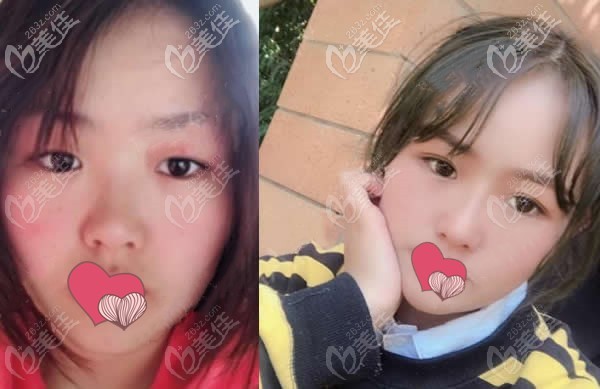 杨琉舒做的埋线双眼皮术前后对比照片