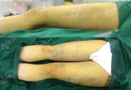 大腿环吸术后即刻效果照