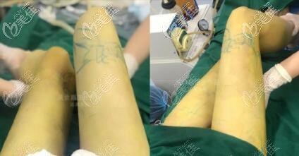 大连达美元辰整形关世超吸脂案例：做完大腿环吸后腿细了很多，效果很明显！