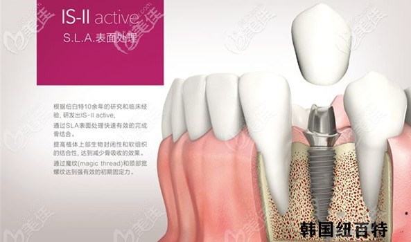 纽百特种植牙特点