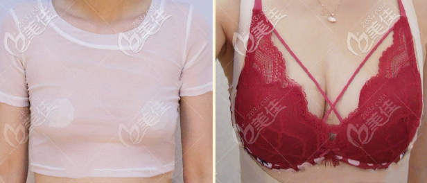 层级活性自体脂肪丰胸300cc效果图