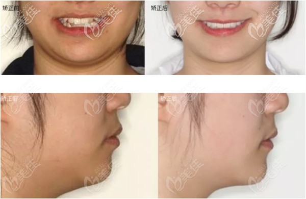 问:你之前有过矫正牙齿的想法吗?