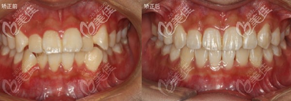 戴隐适美牙套矫正安氏三类错颌畸形后的效果简直堪比整容