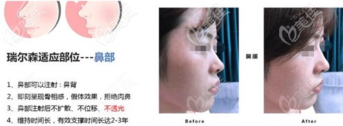 瑞尔森液态骨雕隆鼻的优势