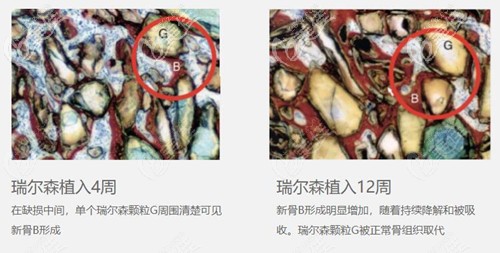 注射瑞尔森液态骨雕隆鼻后的变化