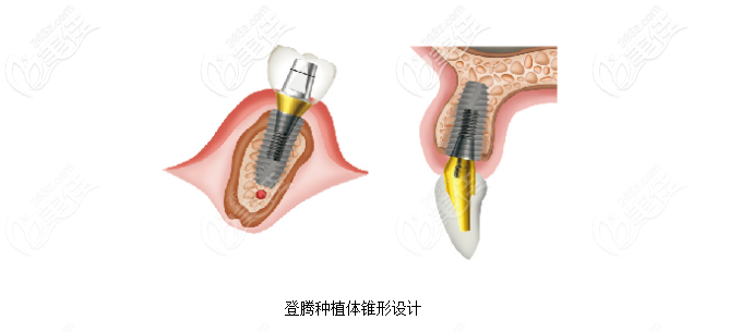 北京圣贝万柳口腔韩国登腾植体