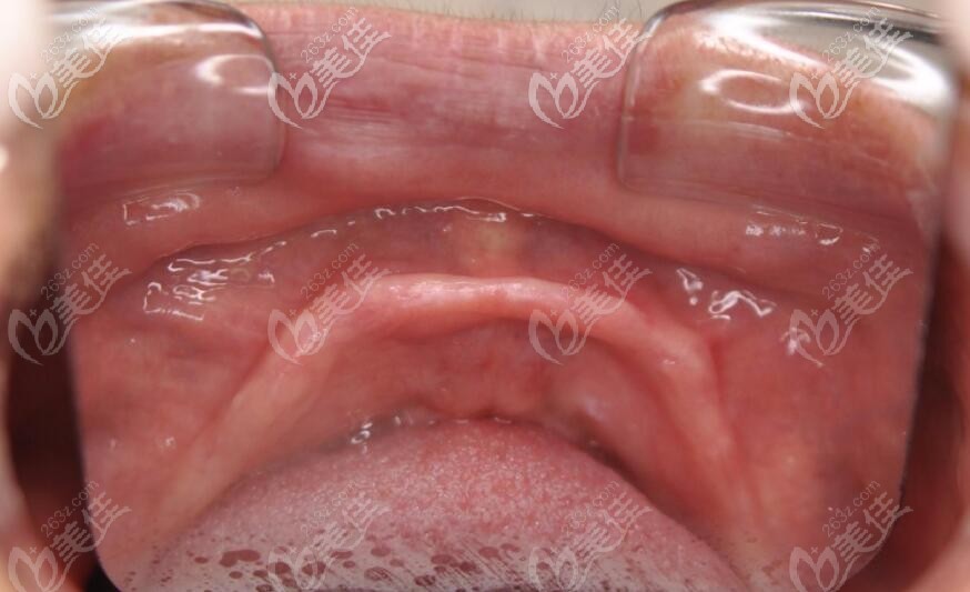 牙龈吸收过多无法直接种植