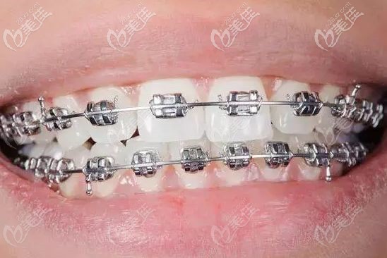 传统金属固定矫正器