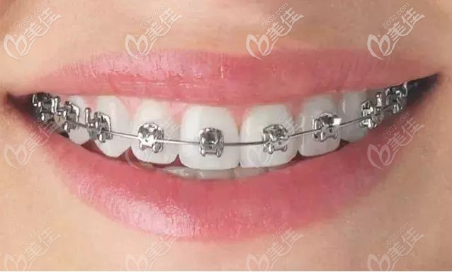 自锁托槽矫治器