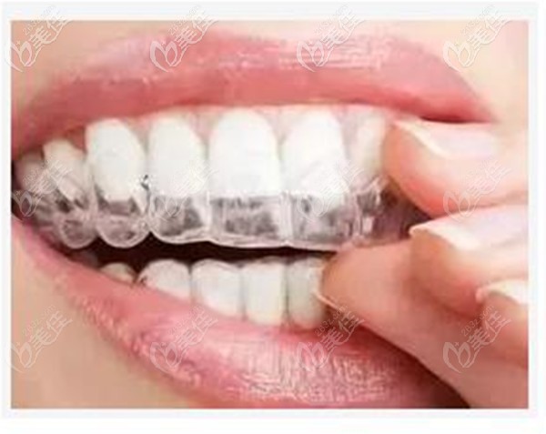 隐形牙套是看不见的变美