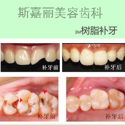 北京斯嘉丽医疗美容3m树脂补牙