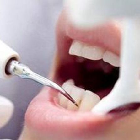 360℃牙周洁治洗牙