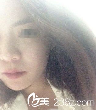 脸部自体脂肪移植