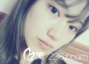 自体脂肪丰额头