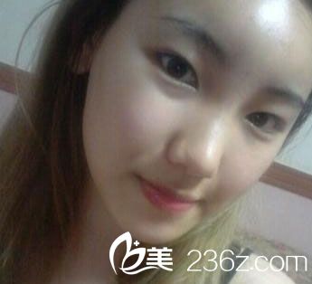 自体脂肪丰额头