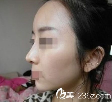 自体脂肪丰额头