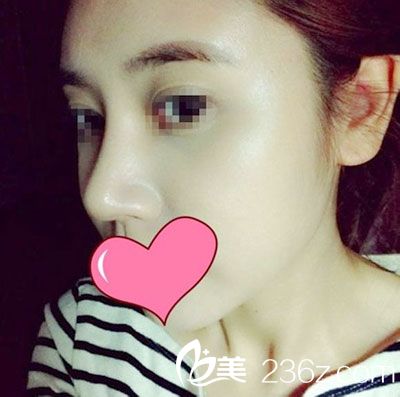 脸部自体脂肪移植