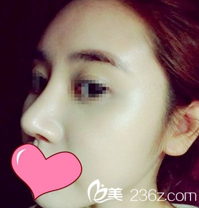 脸部自体脂肪移植