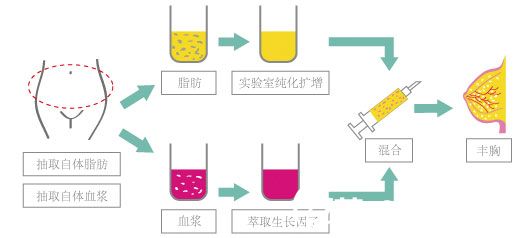 达•芬奇 脂肪美雕TM--丰胸原理